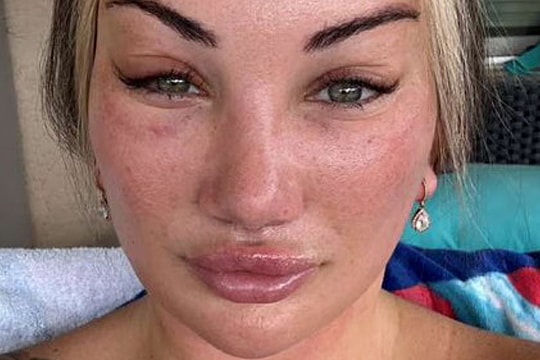 Mặt biến dạng vì filler, cô gái 30 tuổi chi nửa tỷ đồng 'làm lại từ đầu'
