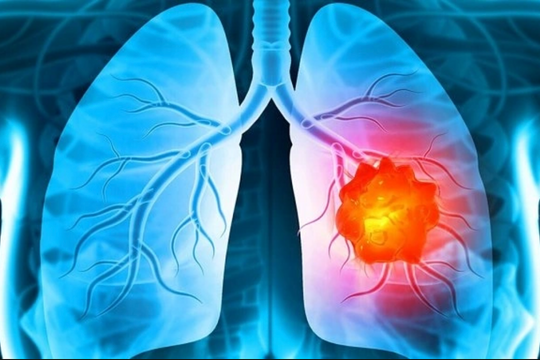Dấu hiệu âm thầm cảnh báo ung thư phổi