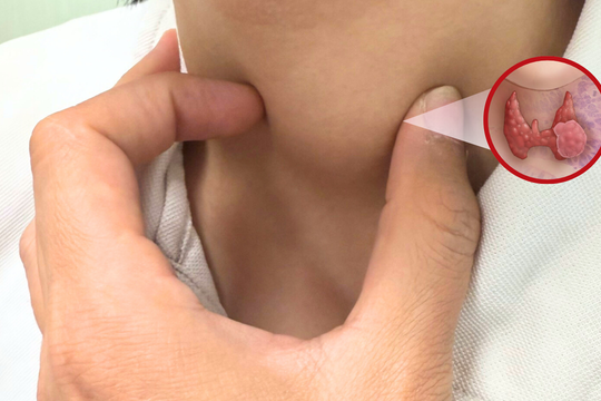 Phẫu thuật thành công ung thư tuyến giáp thể hiếm ở trẻ 13 tuổi