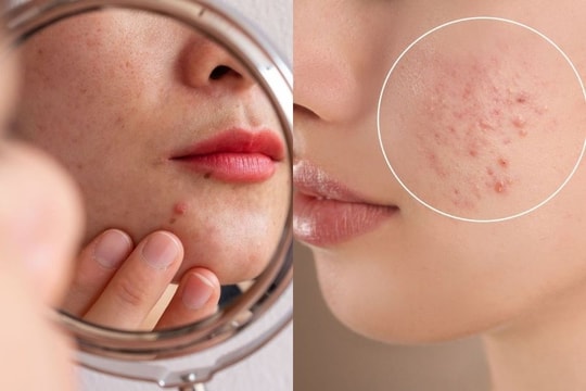 Mụn cứ tái phát, hãy kiểm tra sức khỏe đường ruột của bạn