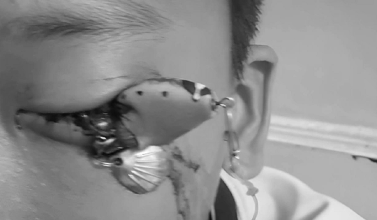 Bé trai 12 tuổi đau mắt dữ dội, bác sĩ gắp ra thứ "đáng sợ" bên trong