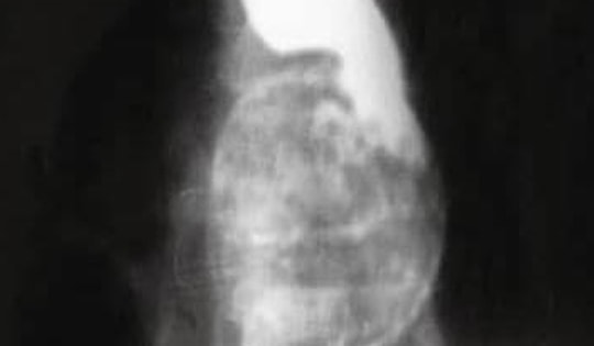 Người phụ nữ bị khó nuốt, bác sĩ phát hiện ra "bí mật" đáng sợ