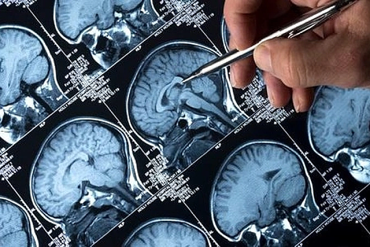 Những thói quen tưởng vô hại có thể gây đột quỵ khi trời lạnh