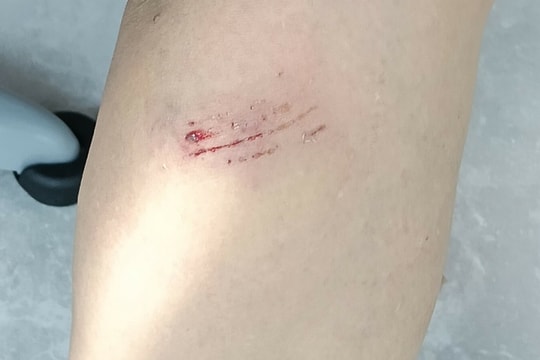 Bỗng dưng bị chó cắn