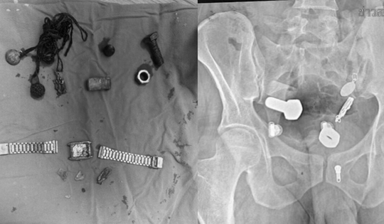 Người đàn ông liên tục đau bụng, bác sĩ sốc nặng khi phát hiện "bí mật" đáng sợ