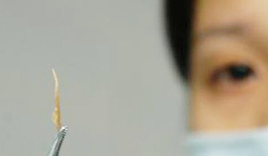 Suýt thủng phế quản vì… mảnh xương cá “đi lạc” suốt 3 tuần trong phổi