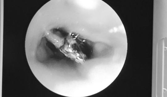 Người phụ nữ 65 tuổi ho suốt ngày, đến viện bác sĩ gắp ra thứ "đáng sợ" bên trong