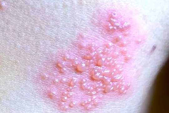 Bỏng rát, đau như kim châm sau khi khỏi zona thần kinh