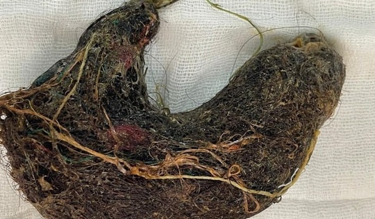 Bé trai đau bụng suốt 2 tháng, bác sĩ phát hiện ra "bí mật" đáng sợ