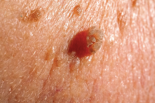 Thiếu nữ 28 tuổi bị sùi mào gà sau quan hệ tình dục