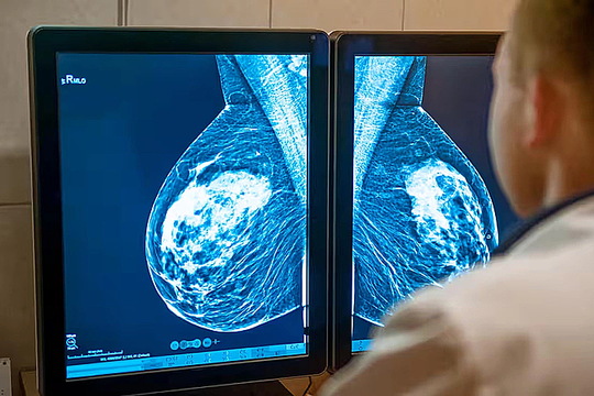 Người đàn ông bị ung thư vú