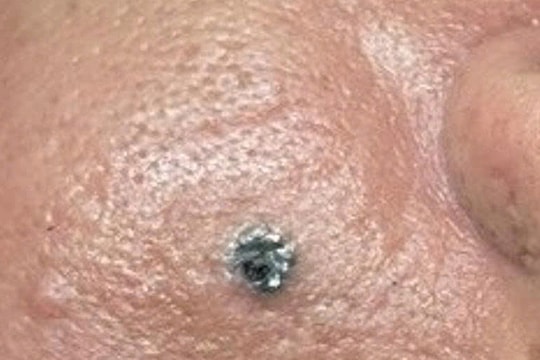 Phát hiện ung thư da từ nốt ruồi rỉ máu