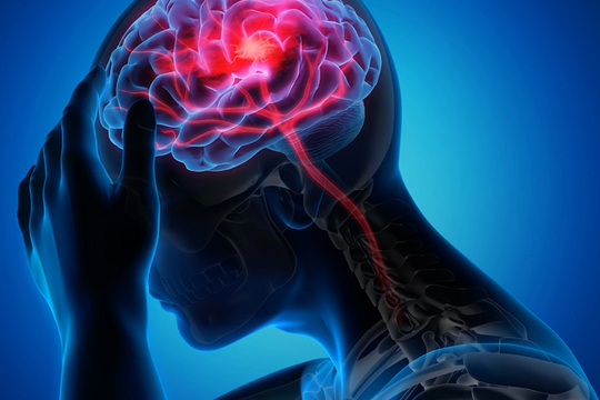 Thường xuyên giận dữ, lo âu dễ đột quỵ?