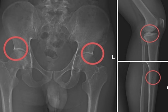 Đường dây tự đục vỡ xương khớp để chiếm tiền bảo hiểm