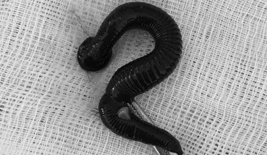 Cụ bà 72 tuổi ngứa mũi liên tục, bác sĩ gắp ra thứ "đáng sợ" bên trong