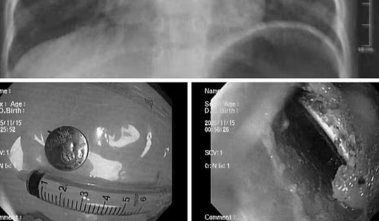 Bé trai bị loét sâu thực quản, bác sĩ gắp ra thứ "đáng sợ" bên trong
