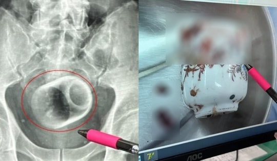 Người đàn ông bị chướng bụng, bác sĩ phát hiện ra bí mật đáng sợ