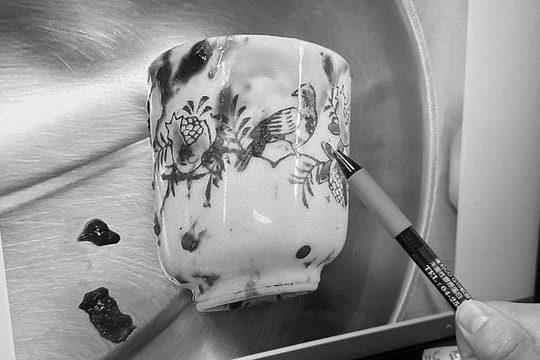 Người đàn ông hoại tử ruột vì chiếc cốc sứ trong hậu môn