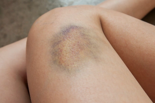 8 dấu hiệu cảnh báo ung thư 'gõ cửa'