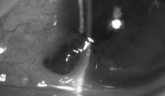 Người đàn ông 27 tuổi đau mắt dữ dội, bác sĩ gắp ra thứ "đáng sợ" bên trong