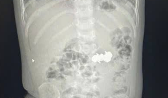 Bé trai 2 tuổi được gia đình đưa đi viện, bác sĩ gắp ra thứ "đáng sợ" bên trong