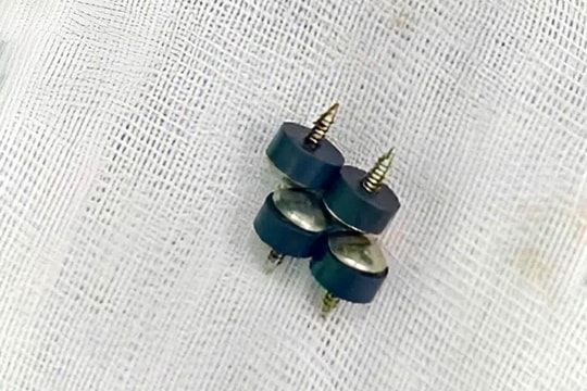 Bé 2 tuổi nuốt 4 đinh nam châm