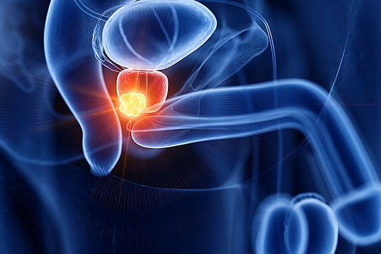 Ai dễ mắc ung thư tiền liệt tuyến?