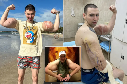 VĐV thể hình Nga nguy cơ cắt bỏ cả hai tay vì tiêm hóa chất