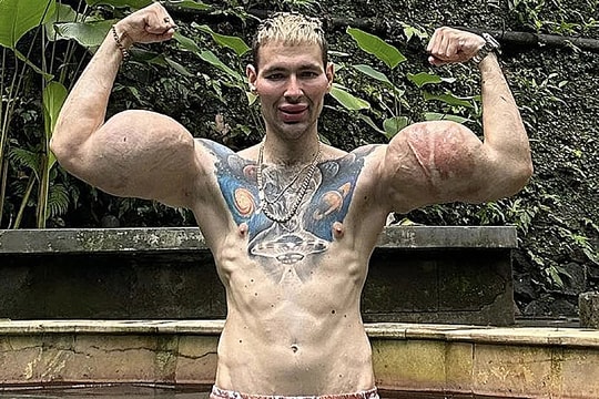 'Quái vật phòng gym' Nga trả giá vì tiêm phồng bắp tay 61 cm