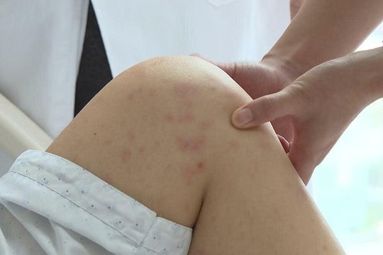 Viêm phổi do biến chứng thủy đậu