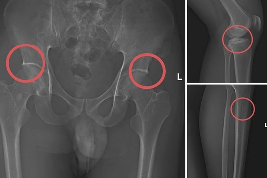 Cách cán bộ y tế dùng búa đinh đục gãy xương chân để trục lợi bảo hiểm