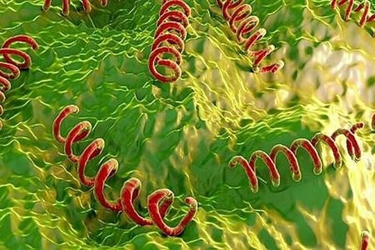 Người đàn ông 65 tuổi mắc giang mai thần kinh