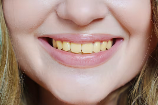 Màu sắc răng tiết lộ điều gì về sức khỏe?