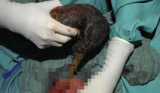 Bé gái đau bụng suốt 10 tháng, bác sĩ phát hiện ra "bí mật" đáng sợ