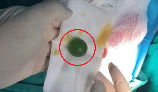 Bé 13 tháng liên tục nôn ói không rõ lý do, sự thật khiến bác sĩ lạnh sống lưng