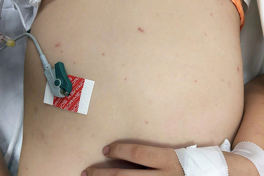 Bệnh não mô cầu - mối đe dọa sức khỏe cộng đồng