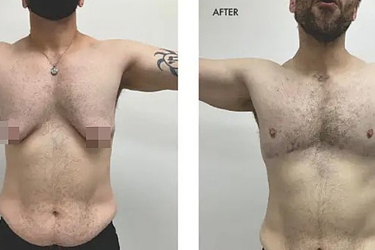 Đàn ông Mỹ chi hàng chục nghìn USD 'dao kéo' thu nhỏ ngực