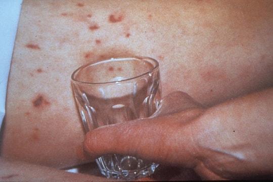 5 sự thật về căn bệnh do vi khuẩn não mô cầu