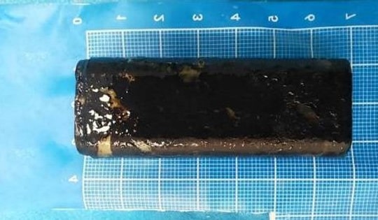 Người đàn ông đau bụng dữ dội, bác sĩ gắp ra thứ "đáng sợ"