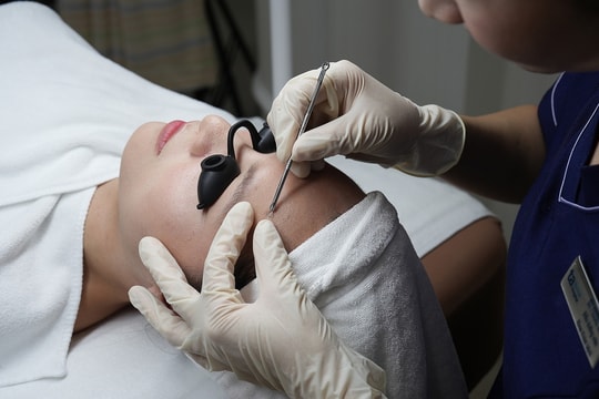 Nổi nhiều mụn sau peel da có đáng lo không?