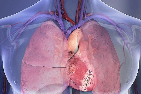 Hút thuốc xả stress, người đàn ông nhồi máu cơ tim