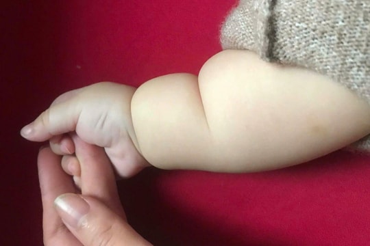 Tay chân trẻ có ngấn do bụ bẫm hay bất thường?