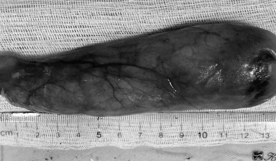 Một tháng chịu nghẹn, người phụ nữ 59 tuổi bàng hoàng khi biết thứ "đáng sợ" nằm trong cổ họng