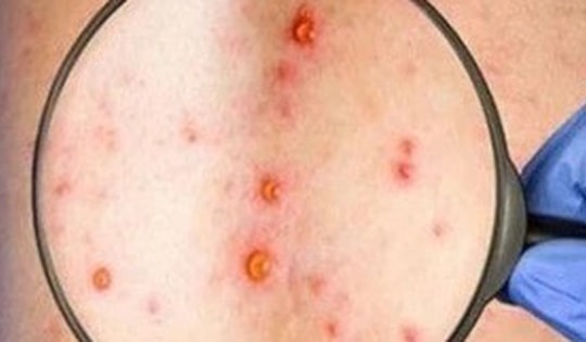 Đồng Nai ghi nhận ca mắc đậu mùa khỉ chưa rõ nguồn lây