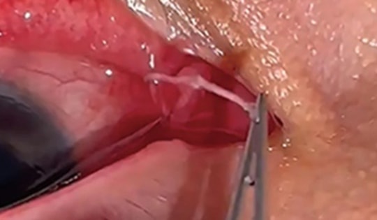 Người phụ nữ đau mắt đi khám, bác sĩ gắp ra thứ "đáng sợ" bên trong