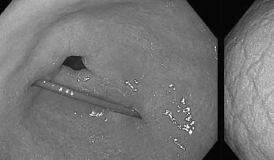 Người phụ nữ đau bụng thốc lên ngực, bác sĩ gắp ra thứ "đáng sợ"