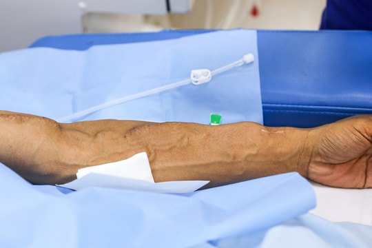 Chi phí chạy thận một tháng hết nửa thu nhập gia đình