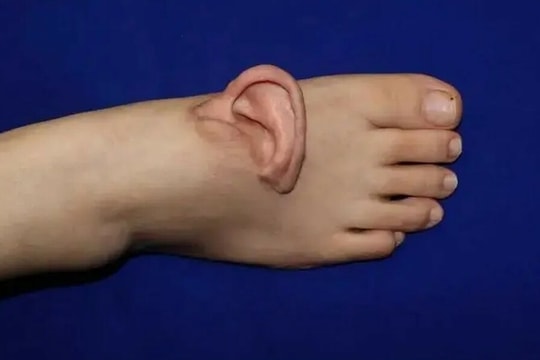 Tai đứt lìa được cấy lại sau 5 tháng 'nuôi' trên chân