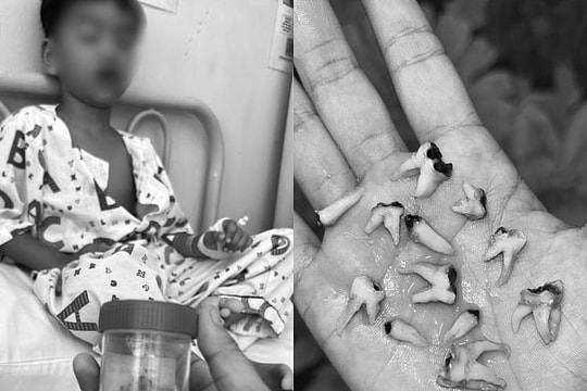 Nhổ 12 răng sâu cùng lúc vì thói quen ngậm bình sữa khi ngủ