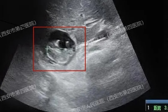 Thai nhi 'làm tổ' trên lá gan người phụ nữ